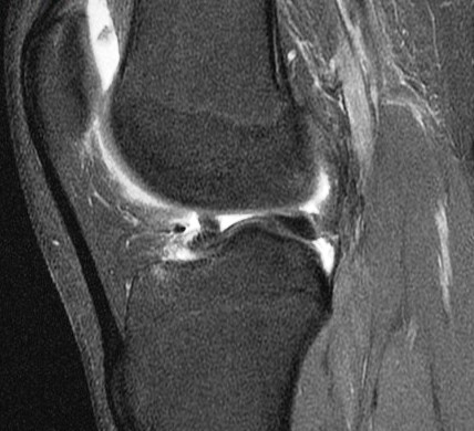 Figure 4 for case Unstable displaced lateral meniscus flap tear( RID2763 )